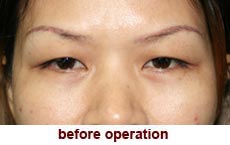 plastic-surgery-blepharoplasty